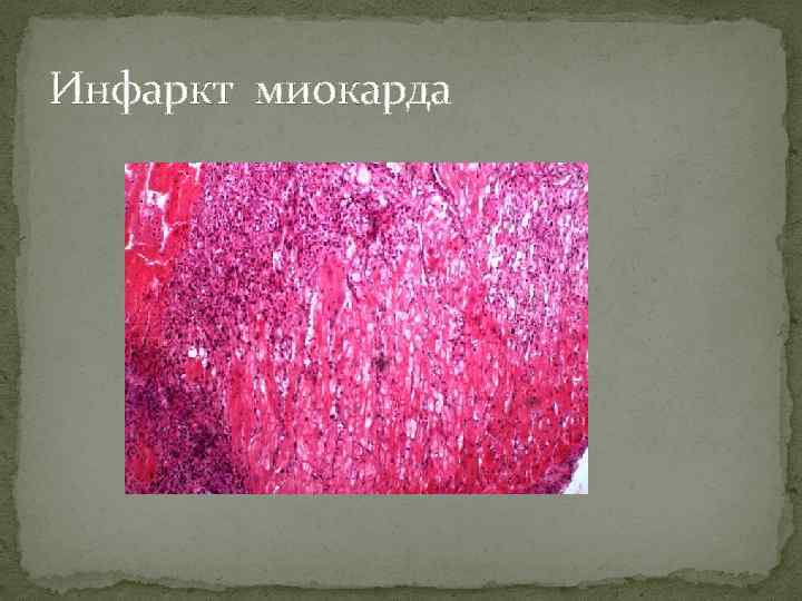 Инфаркт миокарда 