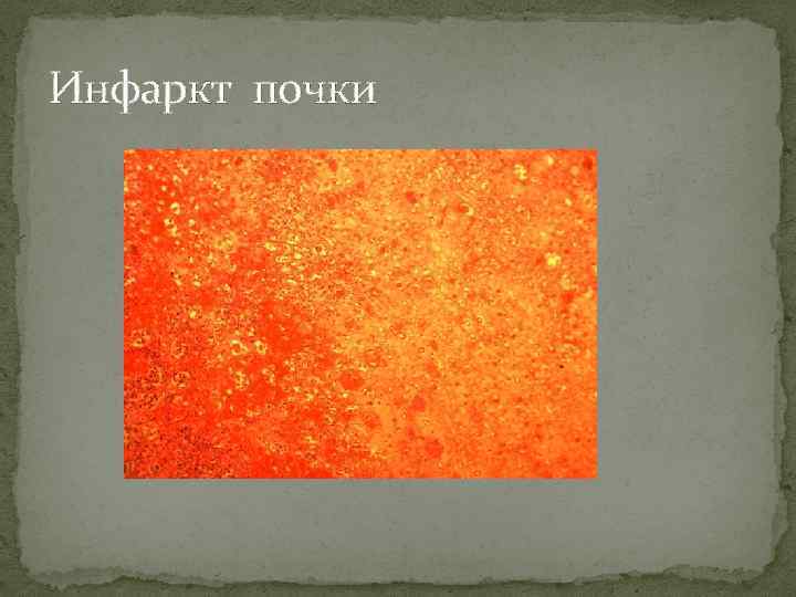 Инфаркт почки 