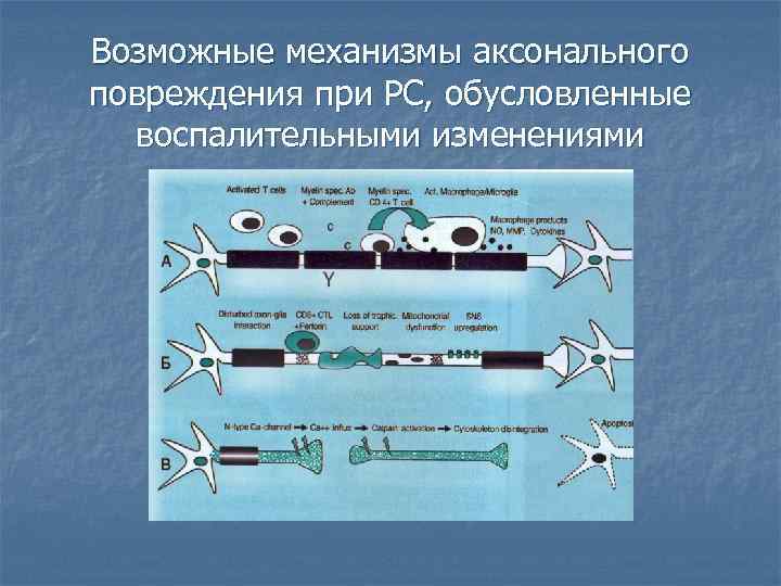 Возможные механизмы аксонального повреждения при РС, обусловленные воспалительными изменениями 
