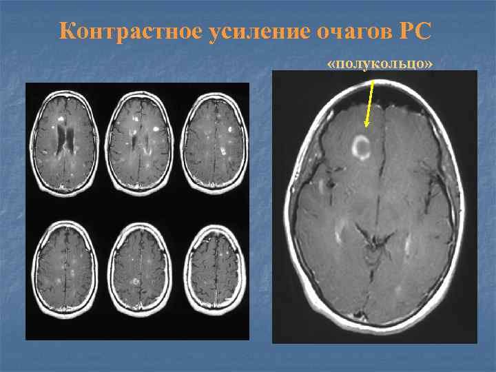Контрастное усиление очагов РС «полукольцо» 