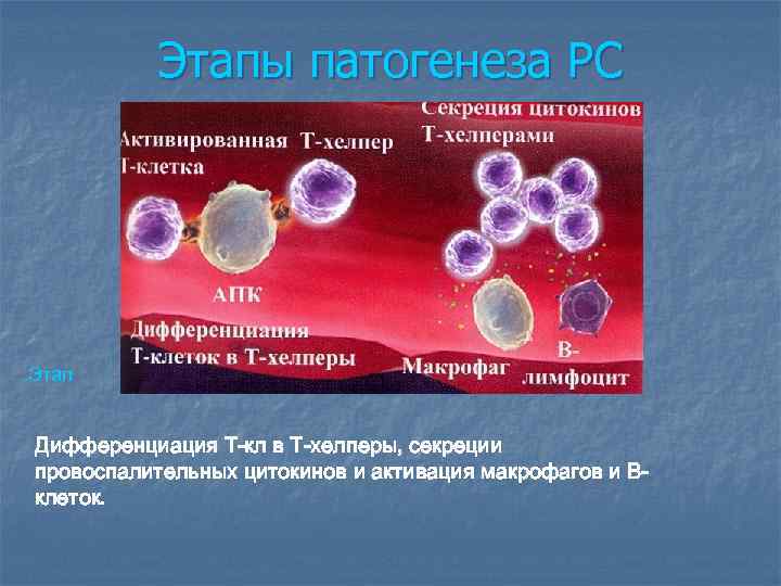 Этапы патогенеза РС . Этап Дифференциация Т-кл в Т-хелперы, секреции провоспалительных цитокинов и активация