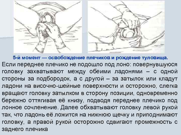 5 -й момент — освобождение плечиков и рождение туловища. Если переднее плечико не подошло