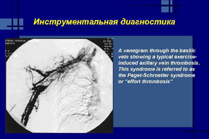 Инструментальная диагностика A venogram through the basilic vein showing a typical exerciseinduced axillary vein