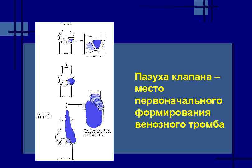 Пазуха клапана – место первоначального формирования венозного тромба 