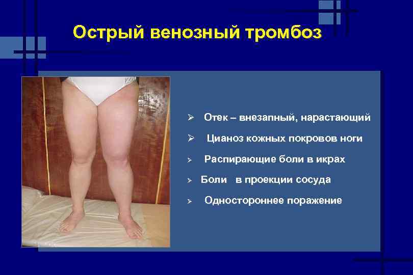 Острый венозный тромбоз Ø Отек – внезапный, нарастающий Ø Ø Цианоз кожных покровов ноги