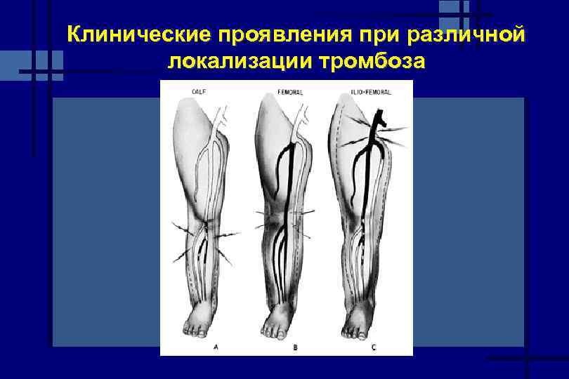 Карта вызова смп тромбофлебит нижней конечности