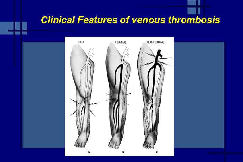 Clinical Features of venous thrombosis 