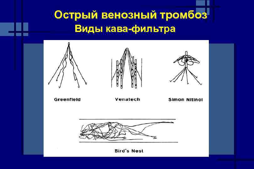 Острый венозный тромбоз Виды кава-фильтра 