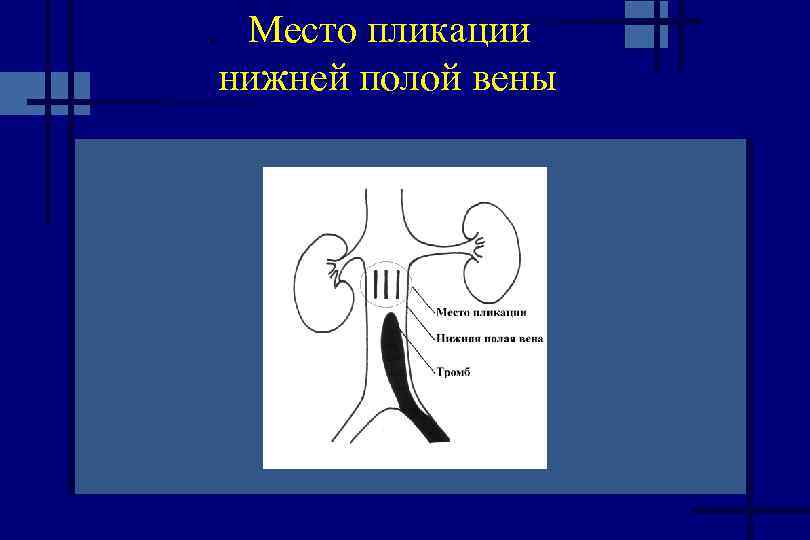 Острые тромбозы системы нижней полой вены презентация