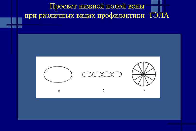 Просвет нижней полой вены при различных видах профилактики ТЭЛА 