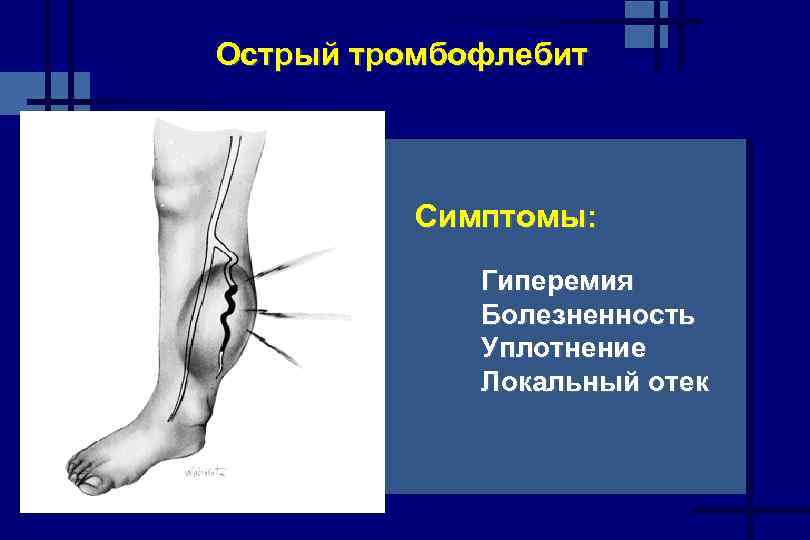 Острый тромбофлебит Симптомы: Гиперемия Болезненность Уплотнение Локальный отек 