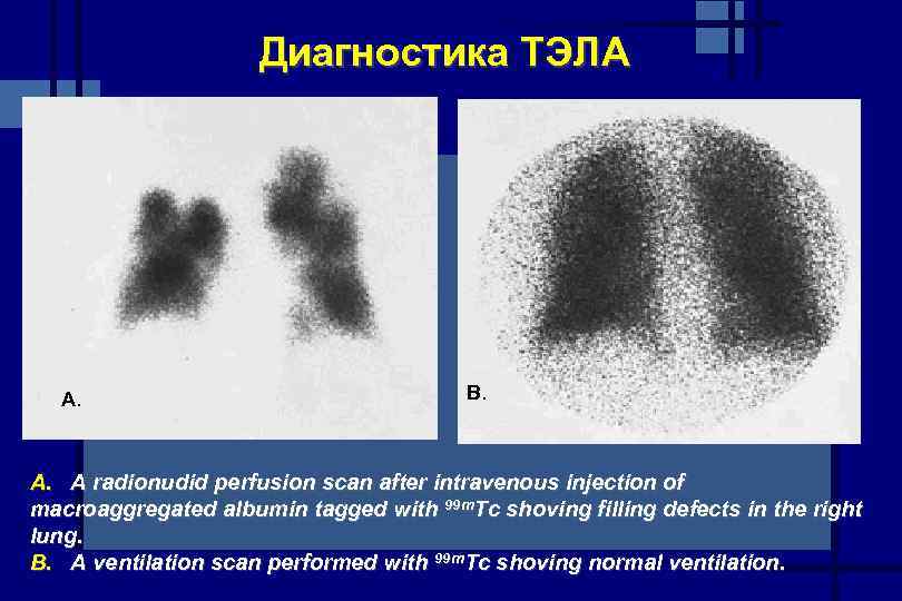 Диагностика ТЭЛА A. B. A radionudid perfusion scan after intravenous injection of macroaggregated albumin