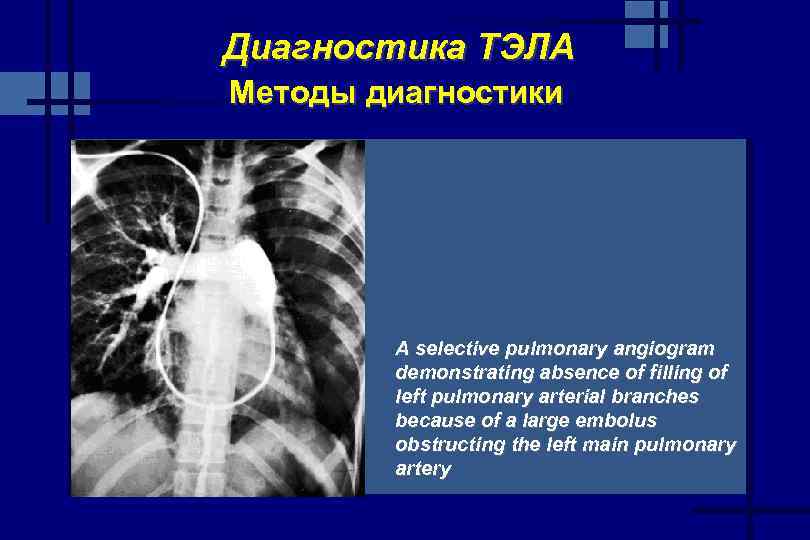 Диагностика ТЭЛА Методы диагностики A selective pulmonary angiogram demonstrating absence of filling of left