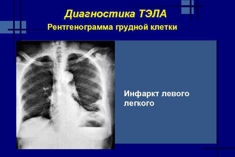 Диагностика ТЭЛА Рентгенограмма грудной клетки Инфаркт левого легкого 