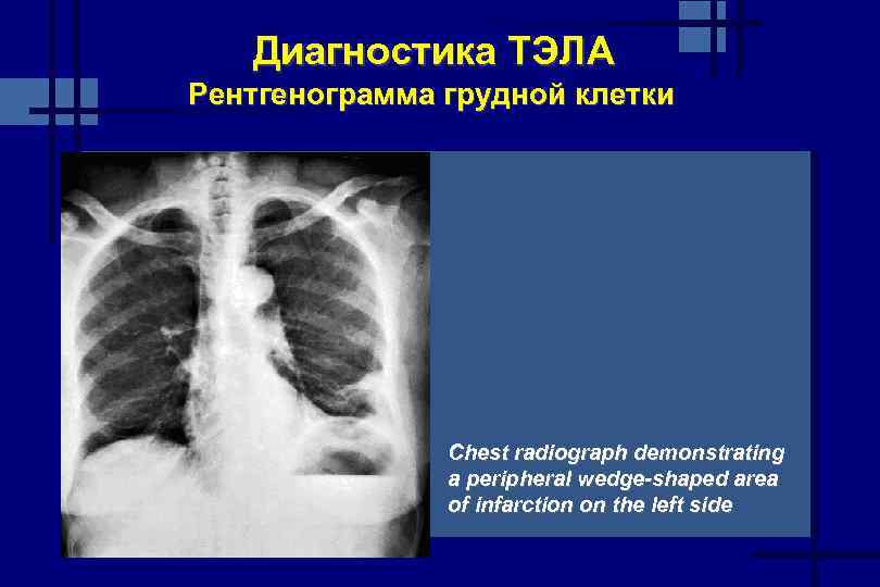 Диагностика ТЭЛА Рентгенограмма грудной клетки Chest radiograph demonstrating a peripheral wedge-shaped area of infarction