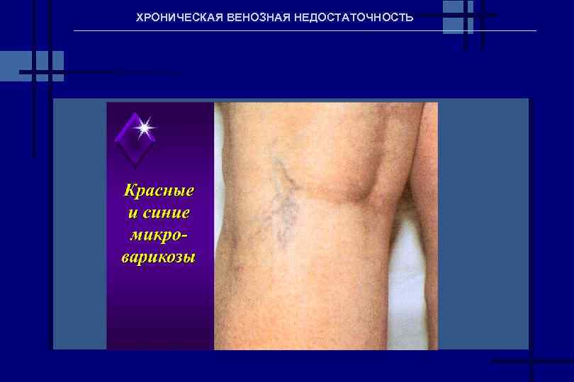 ХРОНИЧЕСКАЯ ВЕНОЗНАЯ НЕДОСТАТОЧНОСТЬ 