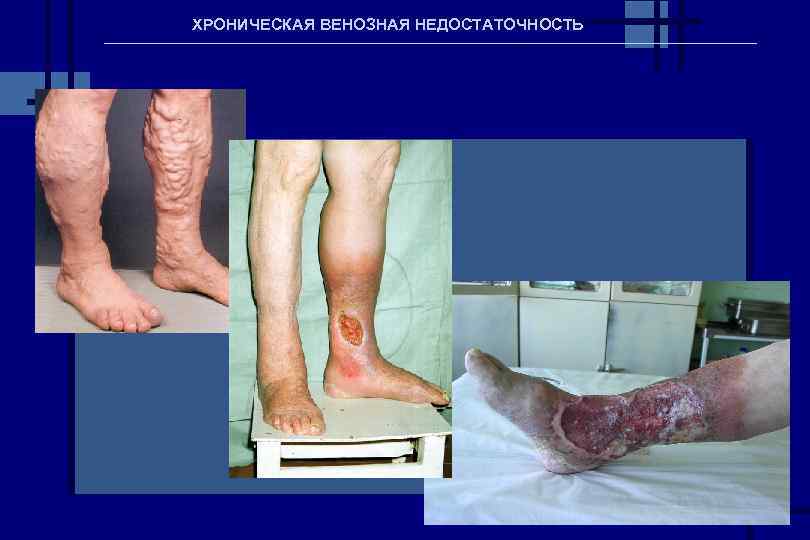 ХРОНИЧЕСКАЯ ВЕНОЗНАЯ НЕДОСТАТОЧНОСТЬ 