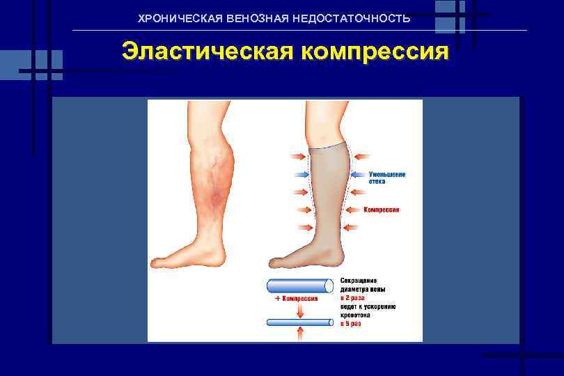 Хроническая венозная недостаточность нижних конечностей фото