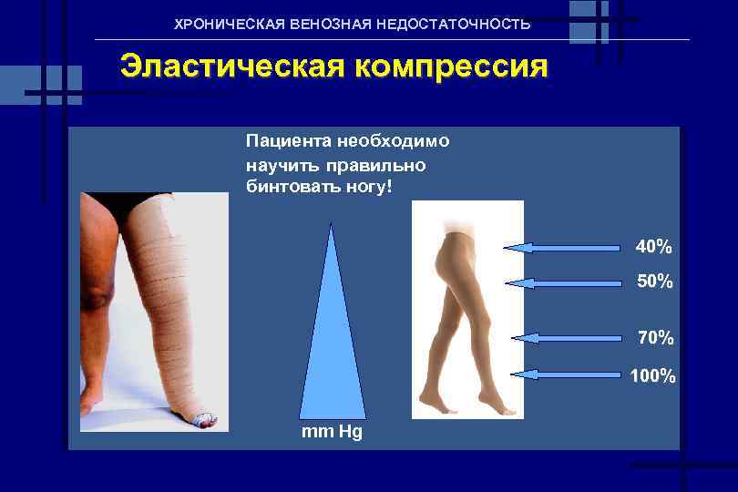 Венозная компрессия. Венозная недостаточность нижних конечностей классификация. Хроническая венозная недостаточность. Хроническая венозная недостаточность нижних конечностей. Эластическая компрессия нижних конечностей.