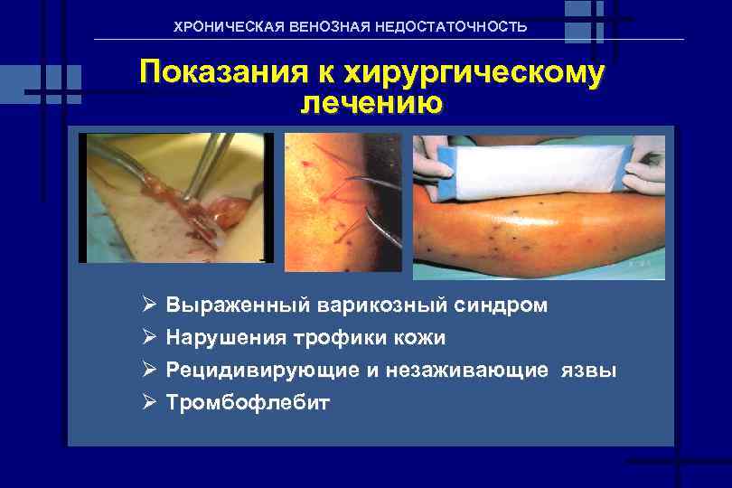 ХРОНИЧЕСКАЯ ВЕНОЗНАЯ НЕДОСТАТОЧНОСТЬ Показания к хирургическому лечению Ø Выраженный варикозный синдром Ø Нарушения трофики