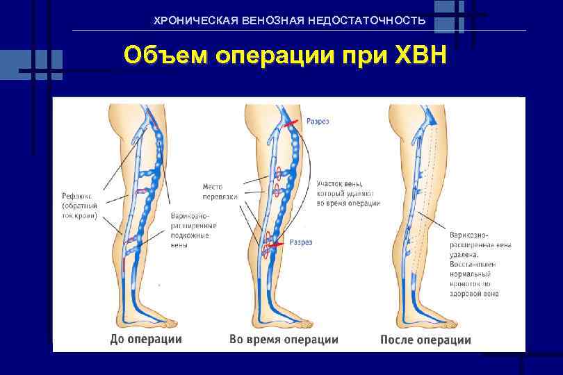 Хроническое венозное. Хроническая венозная недостаточность (ХВН). Степени ХВН нижних конечностей. Стадии ханк нижних конечностей.