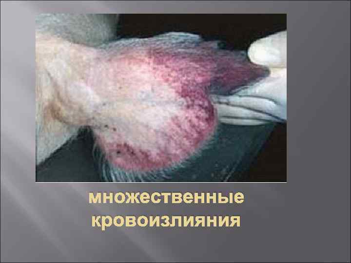 множественные кровоизлияния 