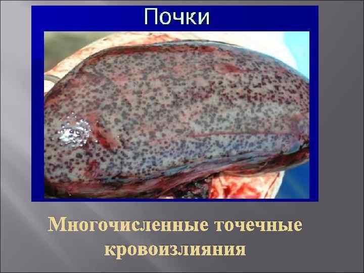 Многочисленные точечные кровоизлияния 