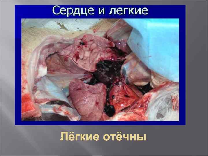 Лёгкие отёчны 