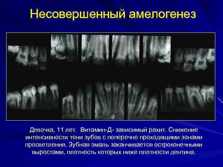 Для разгара рахита характерна следующая рентгенологическая картина