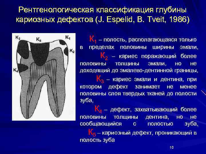 Рентгенологическая классификация глубины кариозных дефектов (J. Espelid, B. Tveit, 1986) в К 1 –