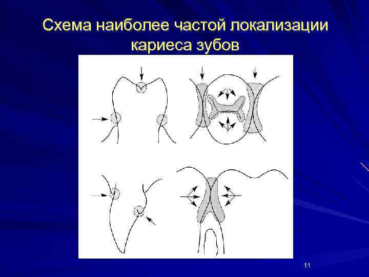 Частая локализация. Наиболее частые локализации кариеса. Кариес зубов по локализации. Укажите наиболее частую локализацию кариеса. Перечислите наиболее частые частые локализации кариеса.