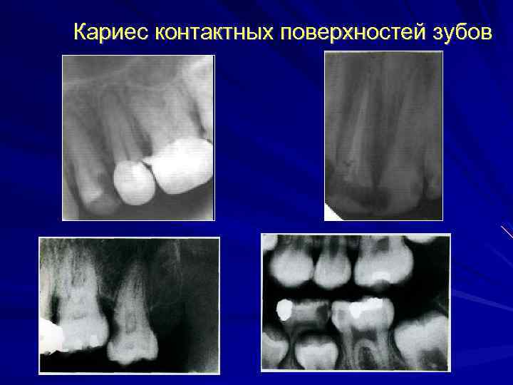 Кариес контактных поверхностей зубов 15 