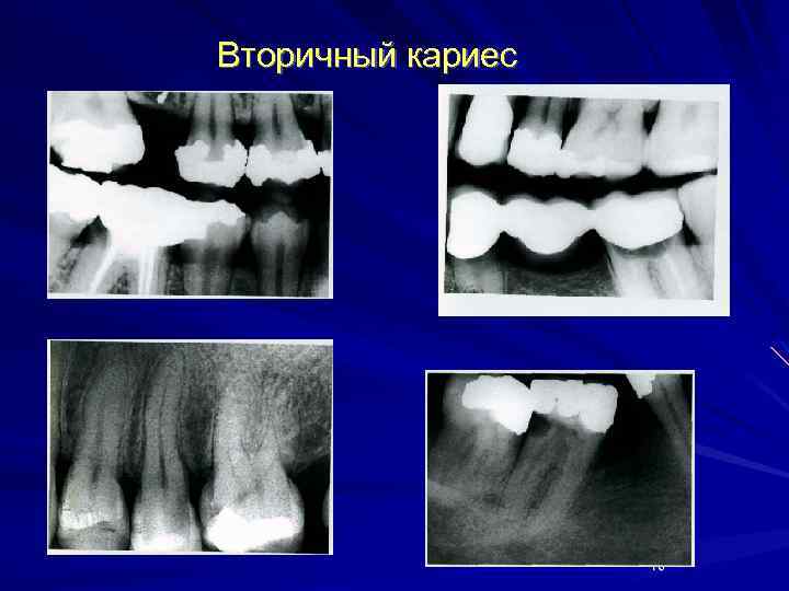 Вторичный кариес 16 