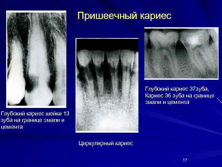 Пришеечный кариес Глубокий кариес 37 зуба, Кариес 36 зуба на границе эмали и цемента