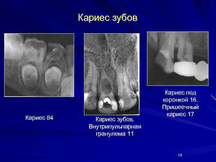 Кариес зубов Кариес 84 Кариес зубов. Внутрипульпарная гранулема 11 Кариес под коронкой 16. Пришеечный