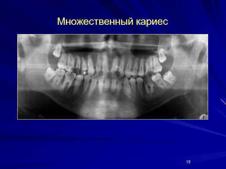 Множественный кариес 19 