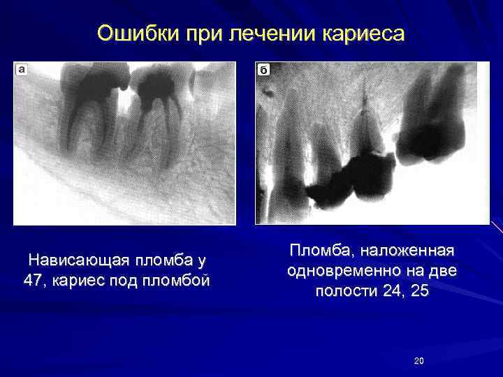 Ошибки при лечении кариеса Нависающая пломба у 47, кариес под пломбой Пломба, наложенная одновременно