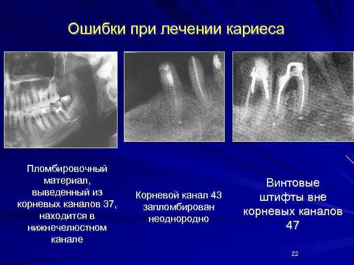 Ошибки при лечении кариеса Пломбировочный материал, выведенный из корневых каналов 37, находится в нижнечелюстном