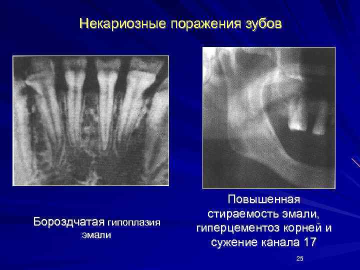 Гиперцементоз корня зуба фото