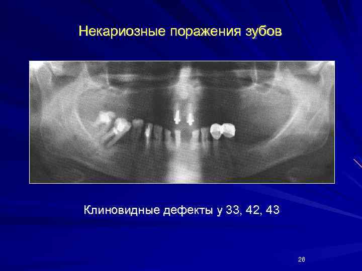 Клиническая картина клиновидного дефекта тест ответы