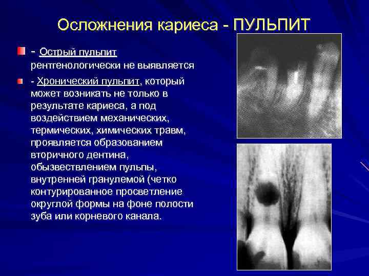 Осложнения кариеса - ПУЛЬПИТ - Острый пульпит рентгенологически не выявляется - Хронический пульпит, который