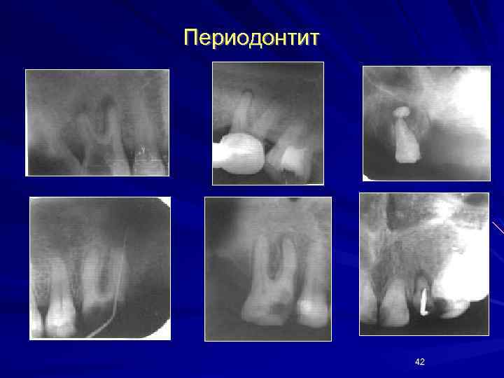 Периодонтит 42 