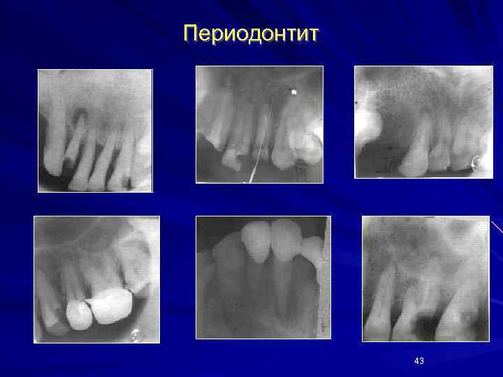 Периодонтит 43 