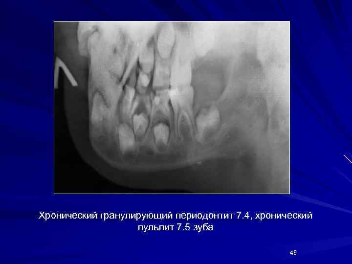 Хронический гранулирующий периодонтит 7. 4, хронический пульпит 7. 5 зуба 46 