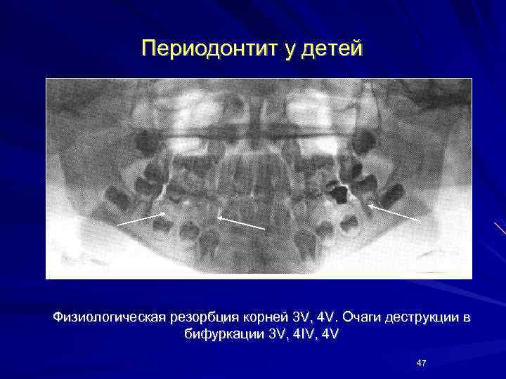 Периодонтит у детей Физиологическая резорбция корней 3 V, 4 V. Очаги деструкции в бифуркации