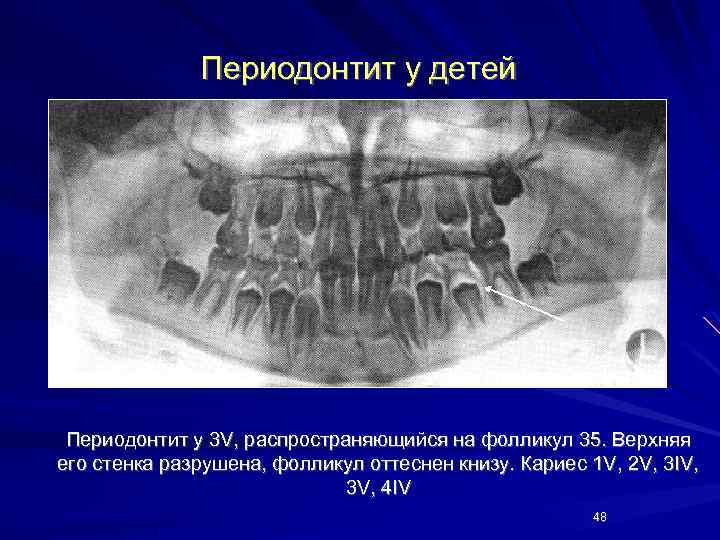 Периодонтит у детей Периодонтит у 3 V, распространяющийся на фолликул 35. Верхняя его стенка