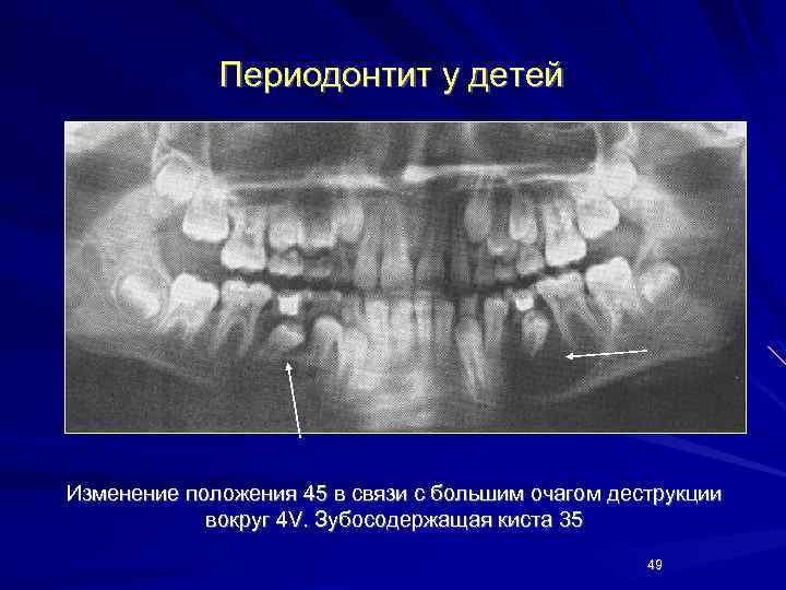 Периодонтит у детей Изменение положения 45 в связи с большим очагом деструкции вокруг 4