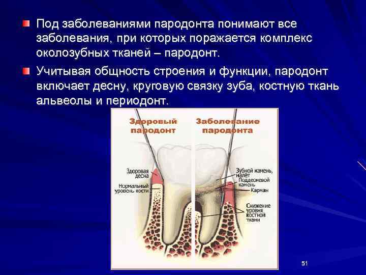 Под заболеваниями пародонта понимают все заболевания, при которых поражается комплекс околозубных тканей – пародонт.