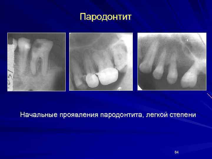 Пародонтит Начальные проявления пародонтита, легкой степени 64 