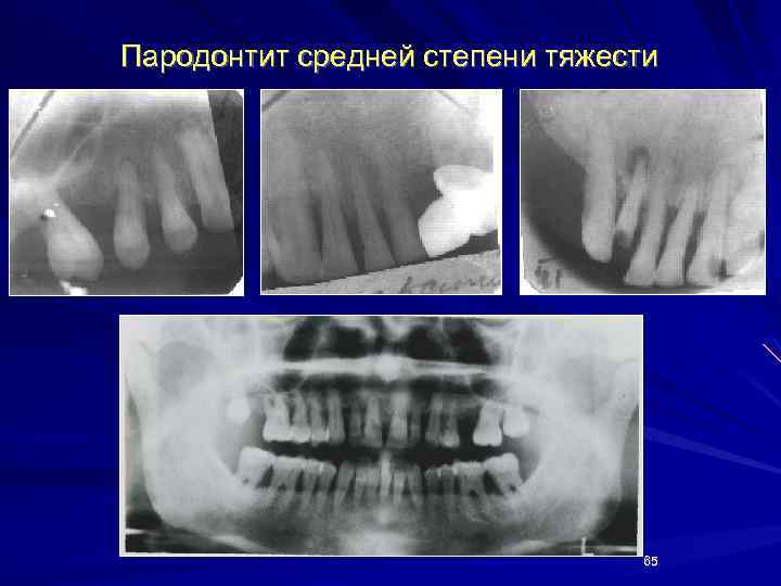 Пародонтит средней степени тяжести 65 